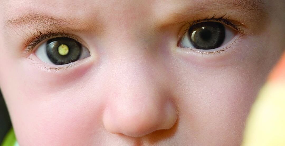 Saiba quais são os tipos mais comuns de câncer nos olhos