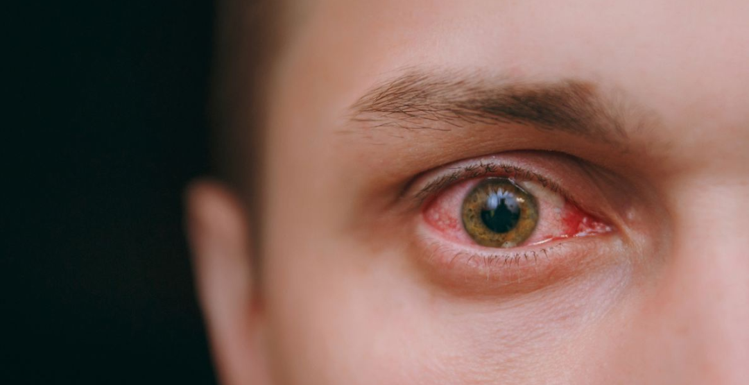 Estudo identifica sífilis ocular com Tomografia de Coerência Óptica