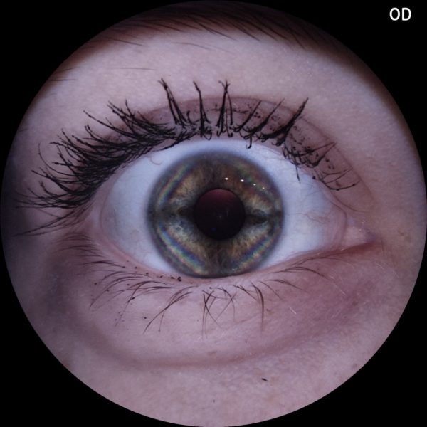 Anterior photo with internal illumination