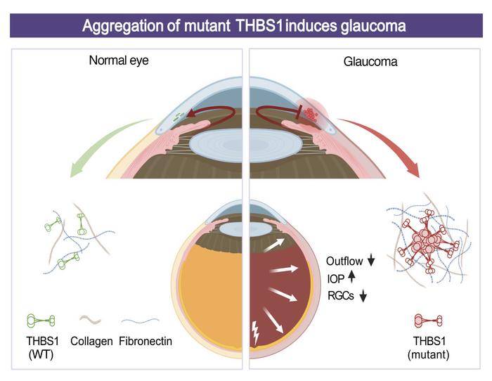 Glaucoma Infantil