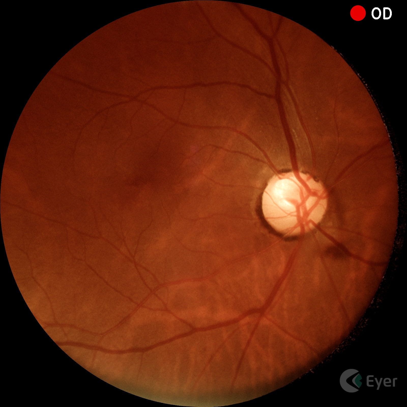 Img Patologia Glaucoma Exame4