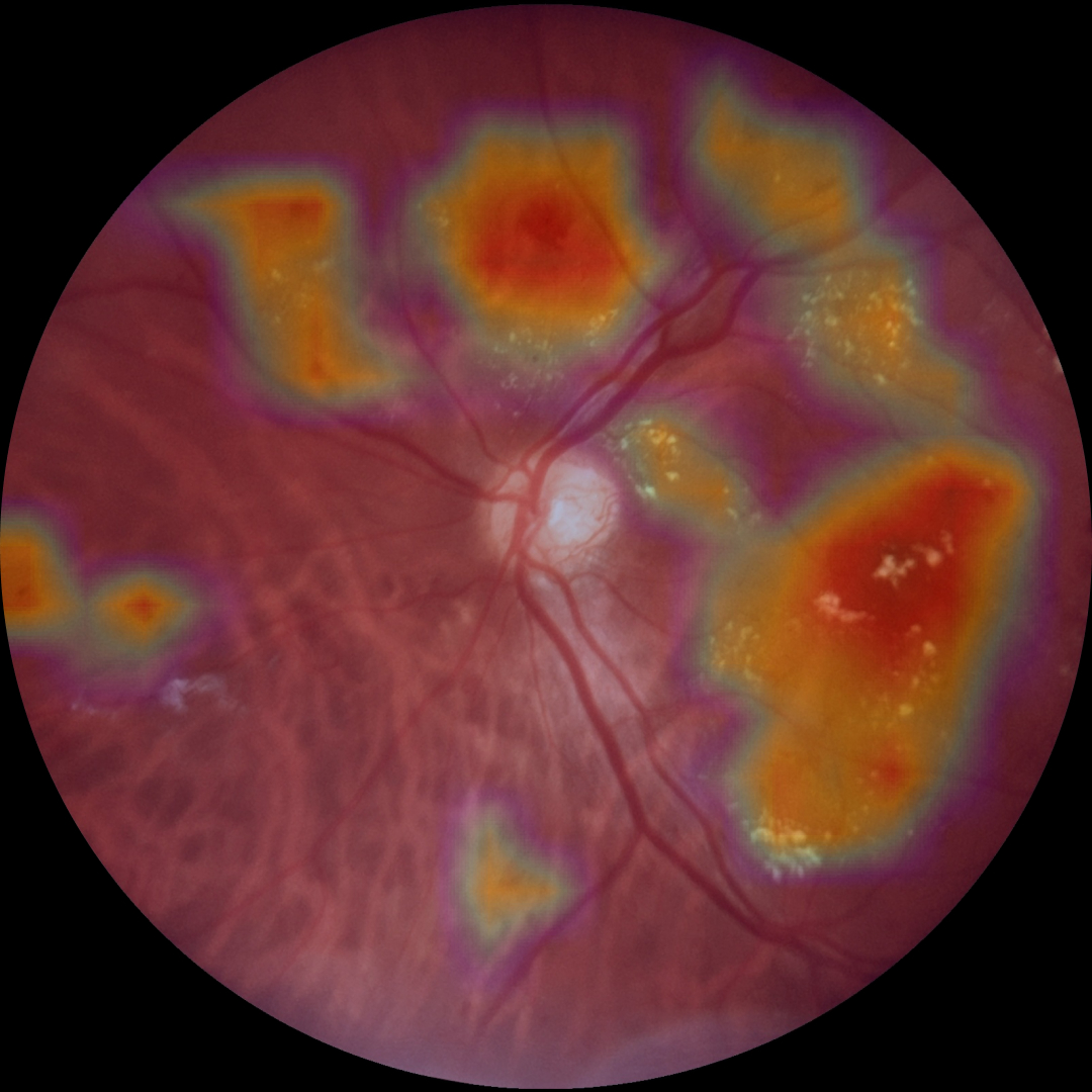 Retina com heatmap