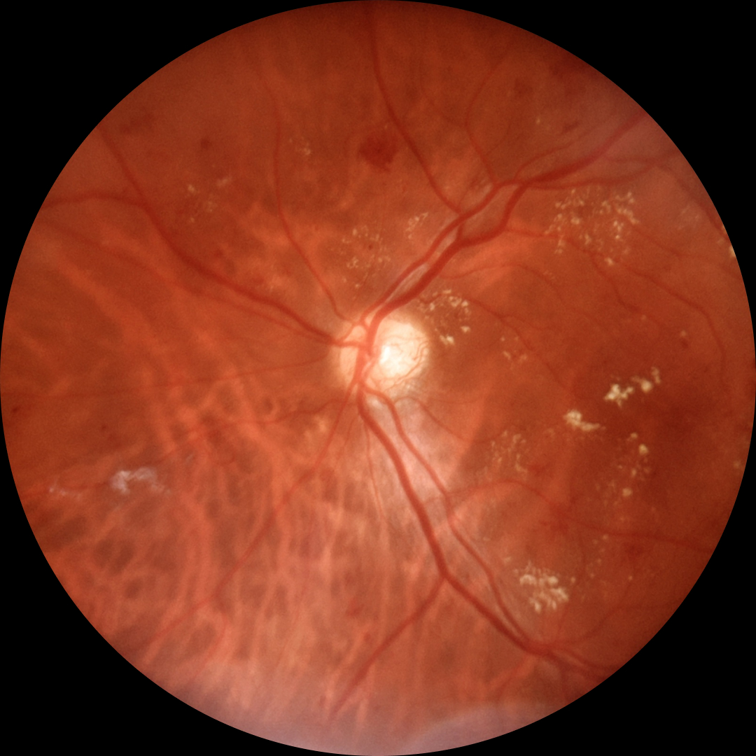 Retina sem heatmap