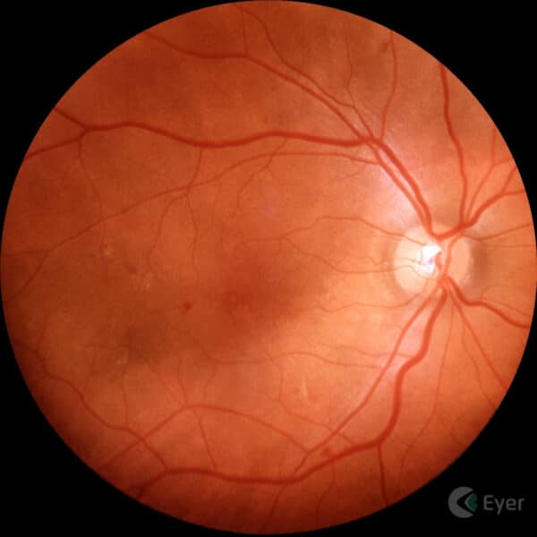 Retinografia colorida realizada com o retinógrafo portátil Eyer da Phelcom Technologies.