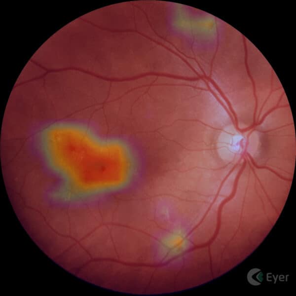 Retinografia feita com o Retinógrafo Portátil Eyer com o mapa de atenção do sistema de inteligência artificial EyerMaps da Phelcom Technologies.