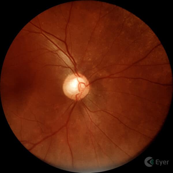 Retinografia colorida realizada com o retinógrafo portátil Eyer da Phelcom Technologies.