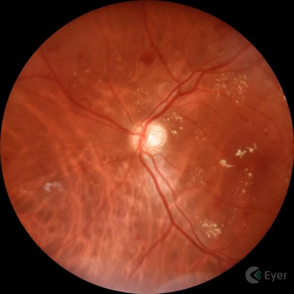 Retinografia colorida realizada com o retinógrafo portátil Eyer da Phelcom Technologies.