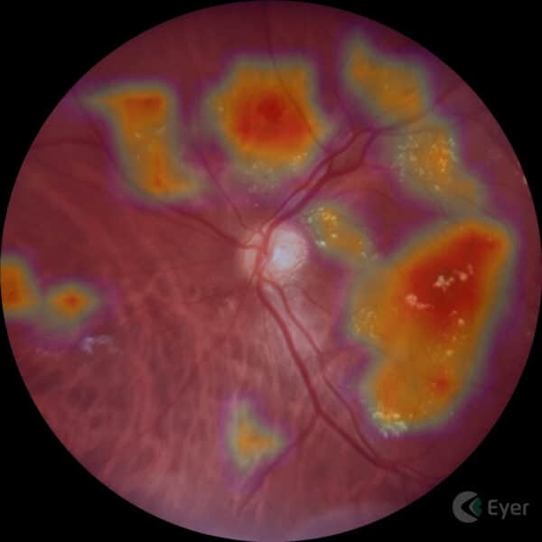 Retinografia feita com o Retinógrafo Portátil Eyer com o mapa de atenção do sistema de inteligência artificial EyerMaps da Phelcom Technologies.