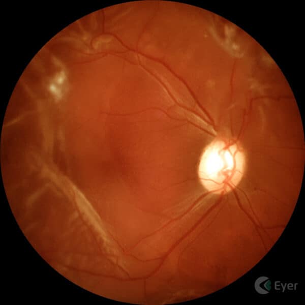 Retinografia colorida realizada com o retinógrafo portátil Eyer da Phelcom Technologies.