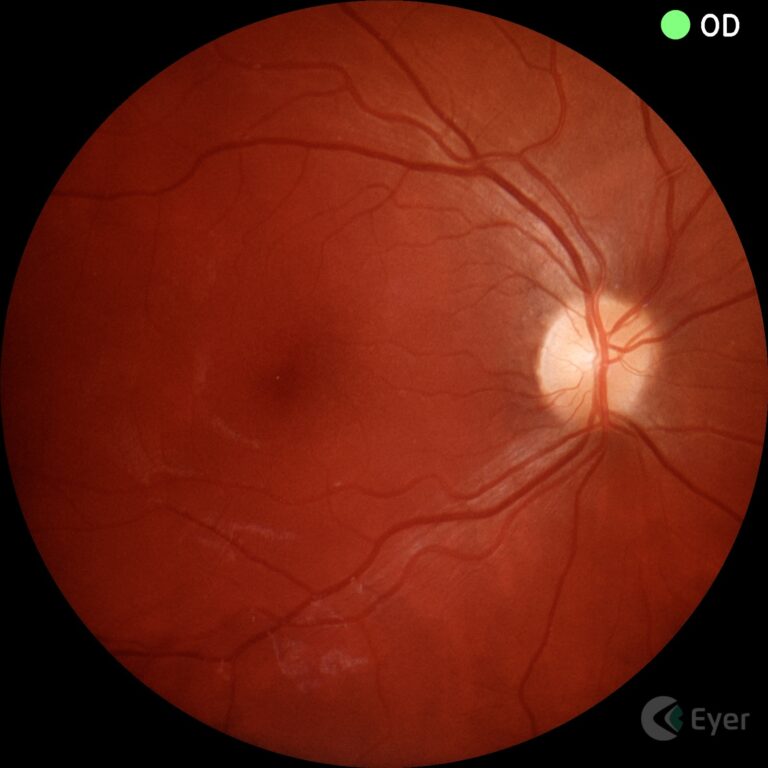 Retinografia colorida realizada com o retinógrafo portátil Eyer da Phelcom Technologies.