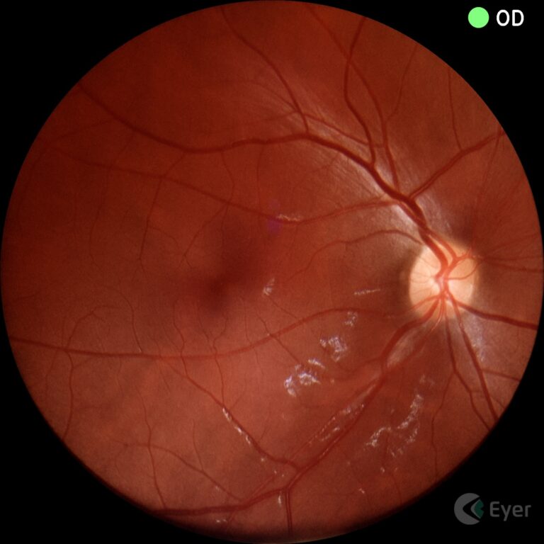 Retinografia colorida realizada com o retinógrafo portátil Eyer da Phelcom Technologies.