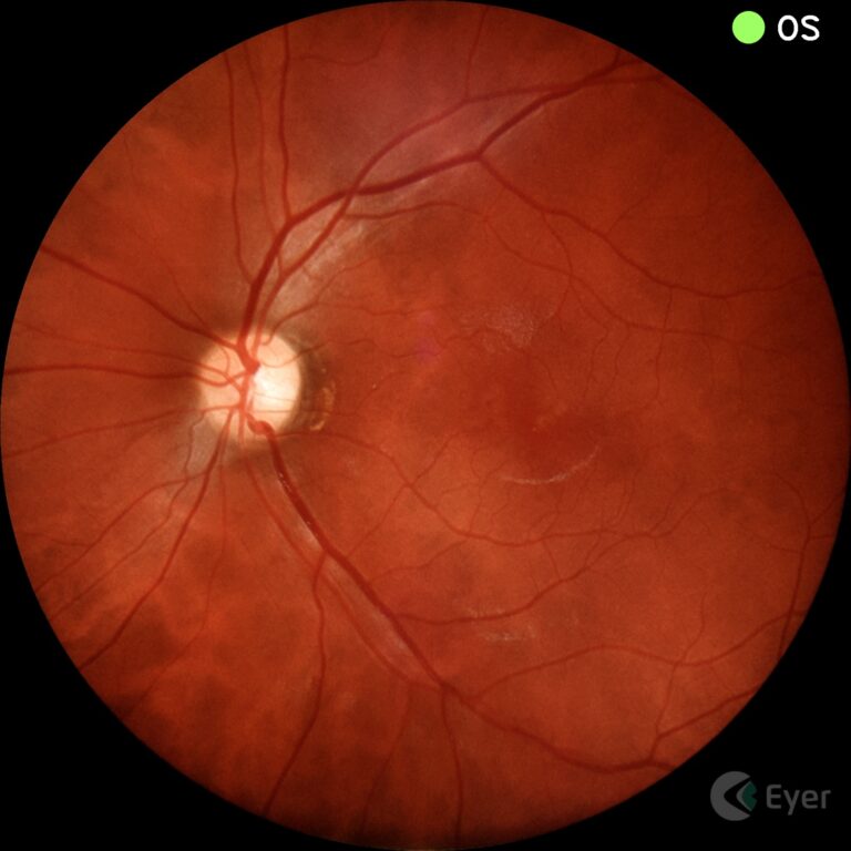 img_retinografia_colorida_eyer