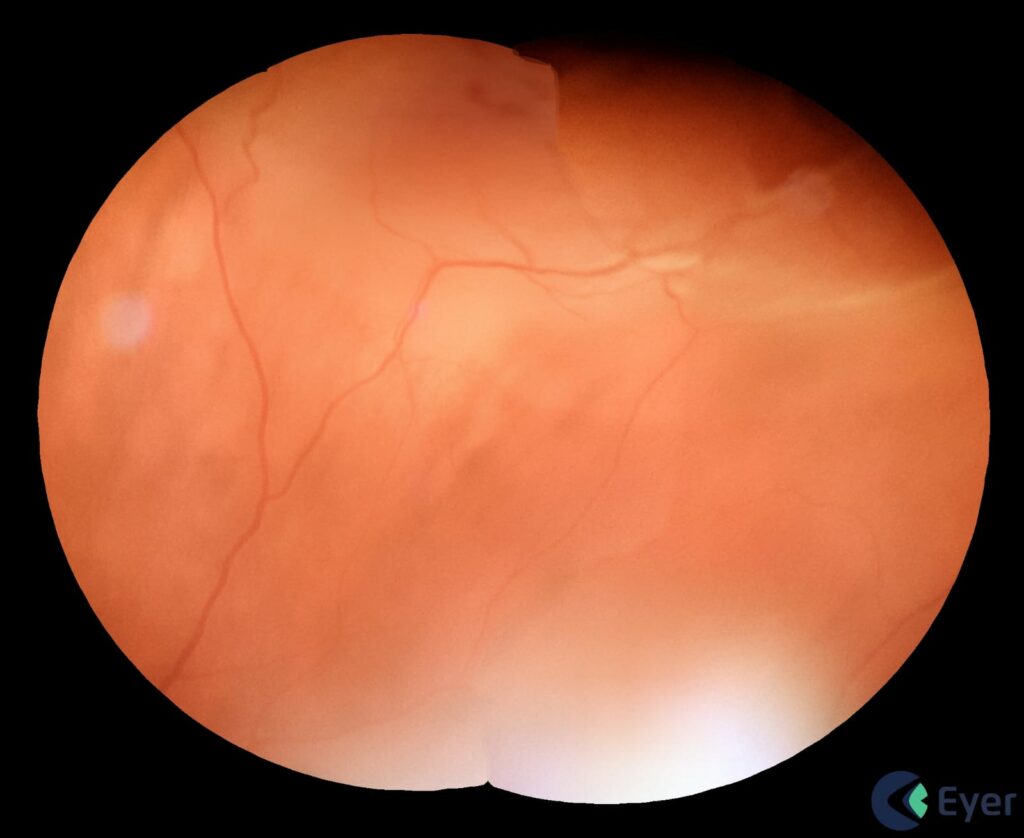 Img Imagem De Fundo De Olho Feita Com Eyer De Paciente Com Deslocamento De Retina