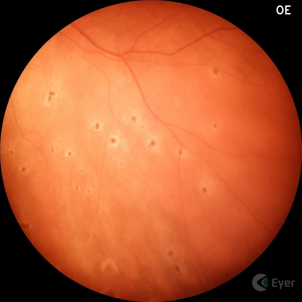 Img Imagem De Fundo De Olho Feita Com Eyer De Paciente Com Microembilizacoes Na Coroide Devido A Covid