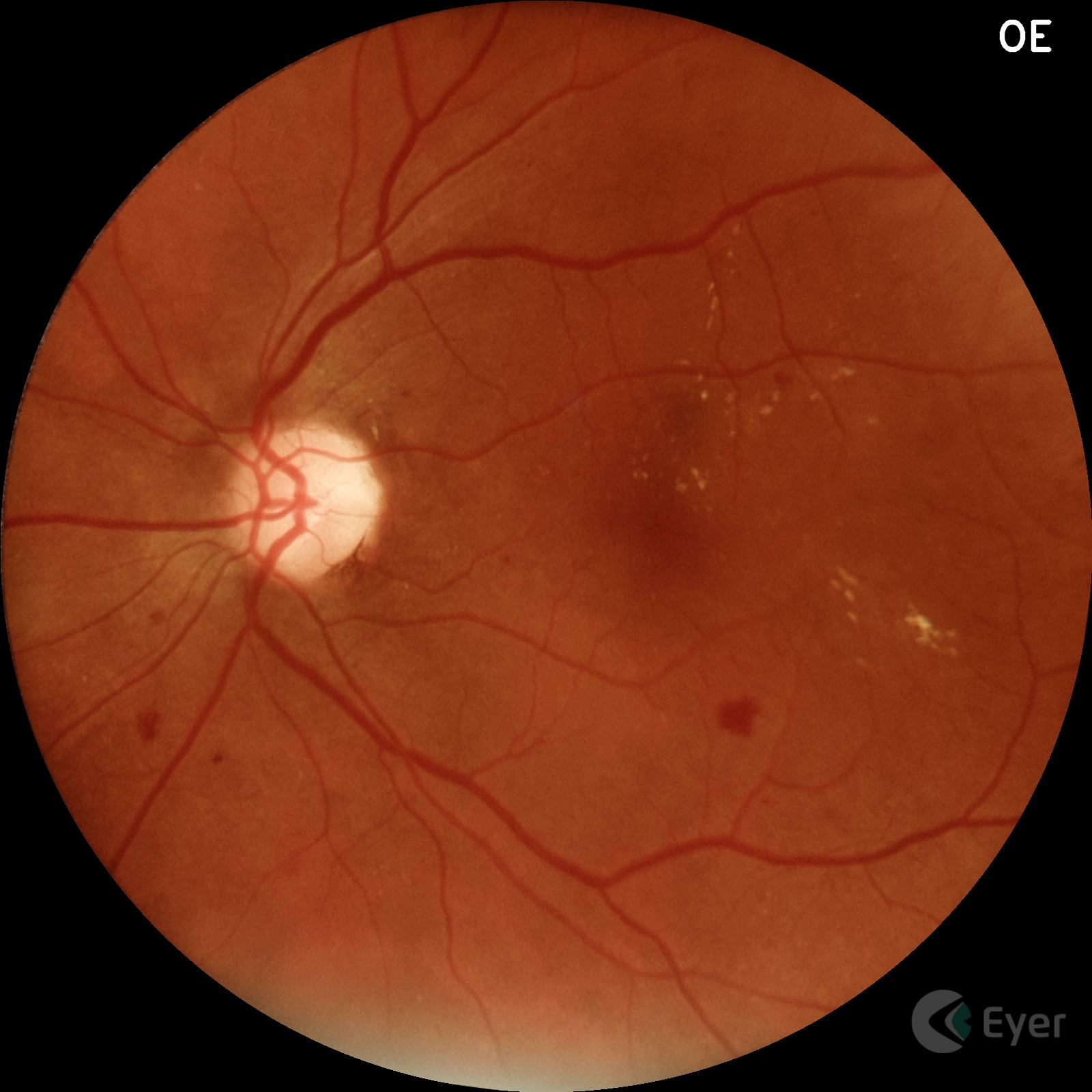 Img Retina Retinopatia