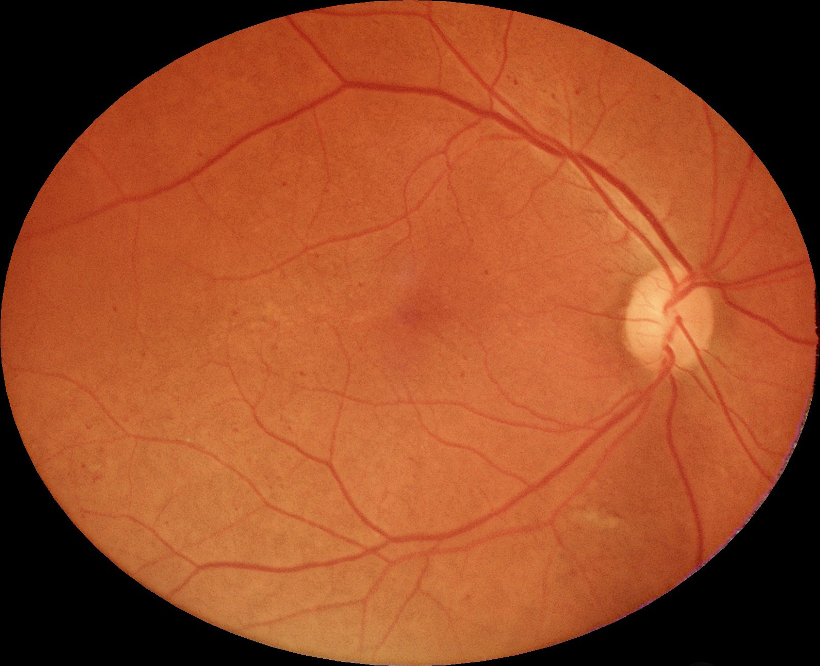 Retina sem heatmap