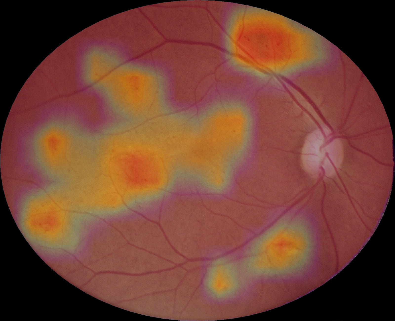 Retina com heatmap