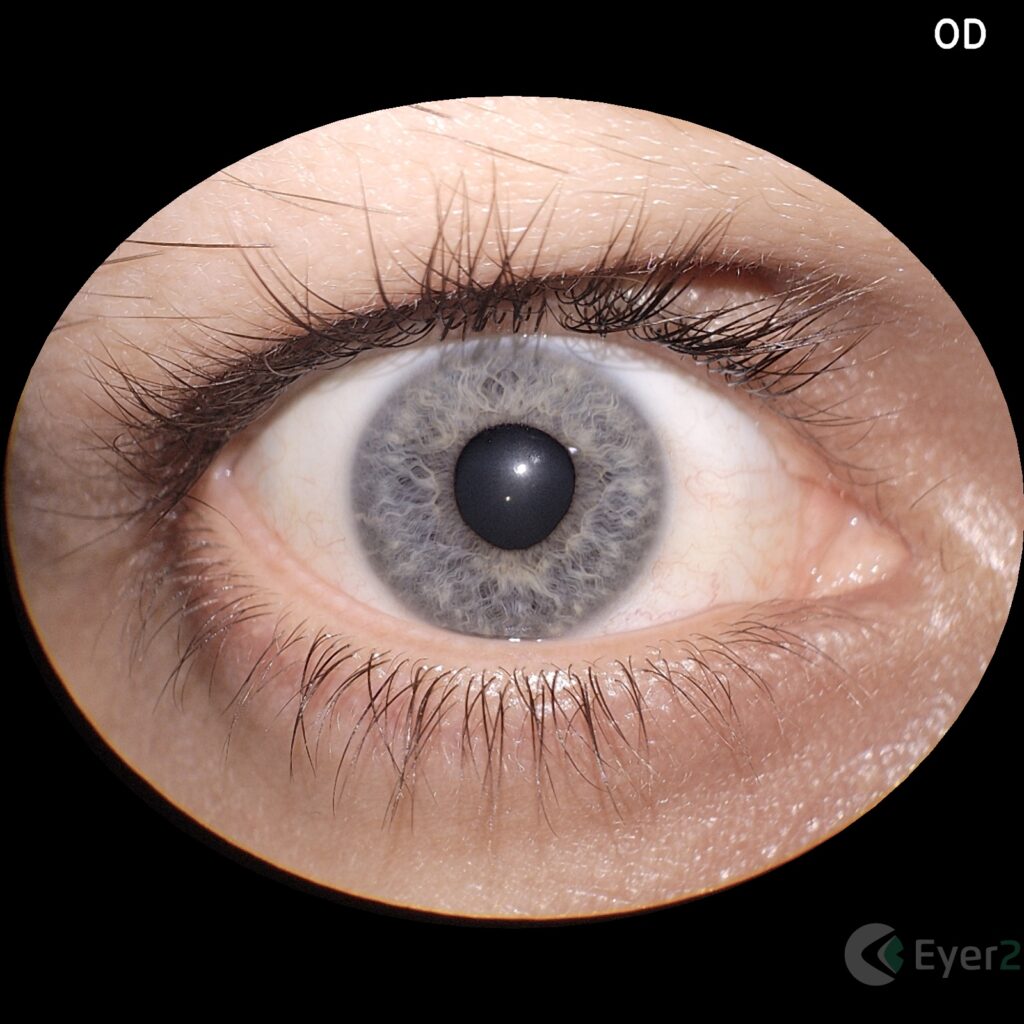 Img Segmento Anterior Eyer2 4 1