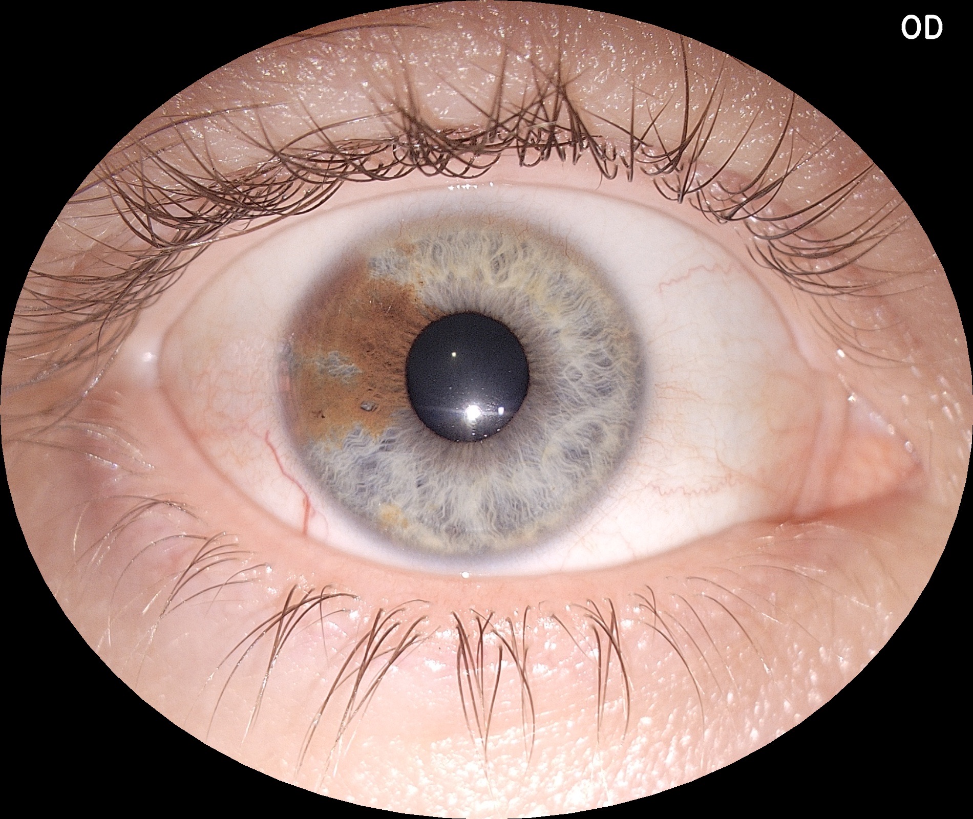 img_segmento_anterior_eyer2_01