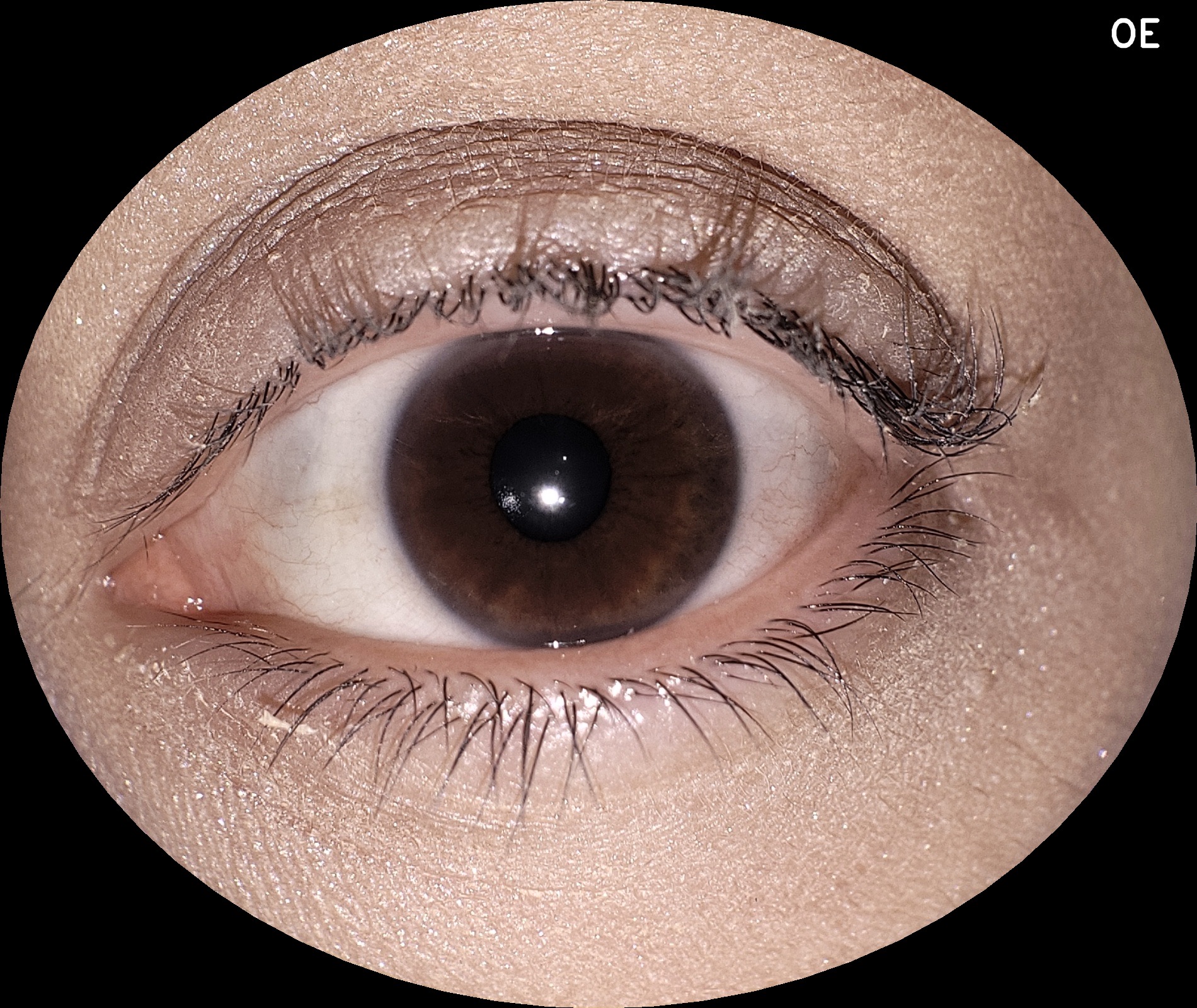 img_segmento_anterior_eyer2_03