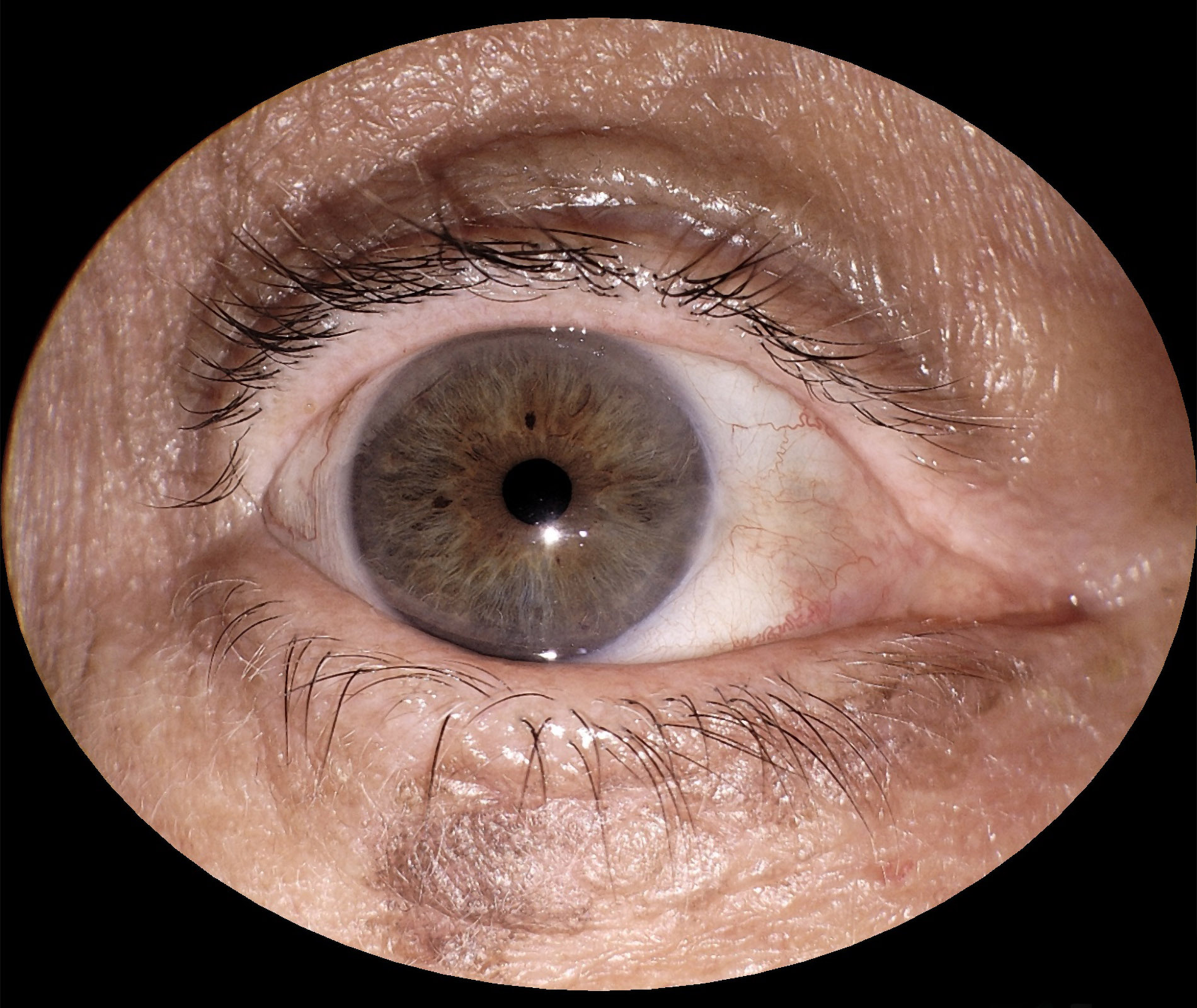 img_segmento_anterior_eyer2_06