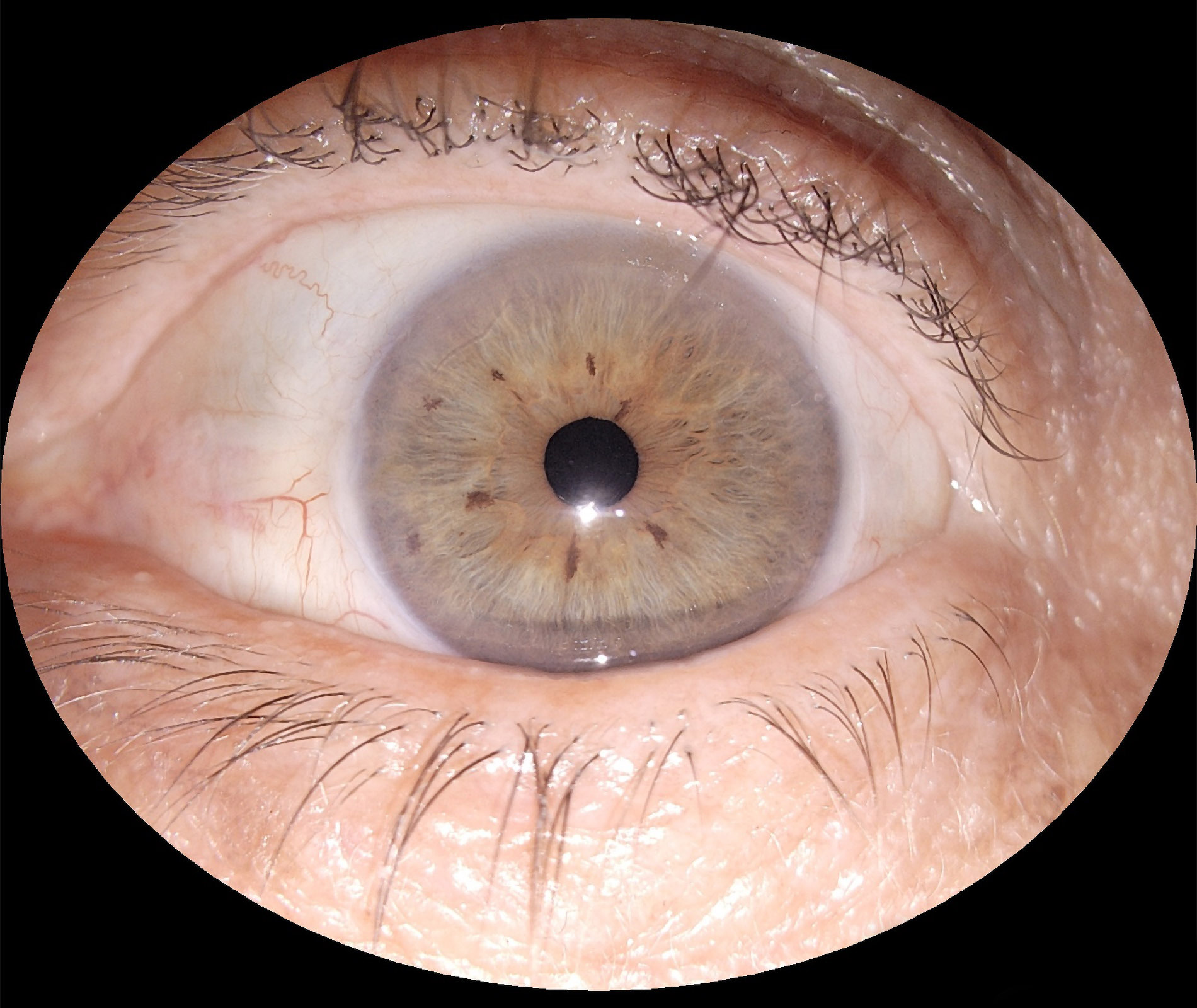 img_segmento_anterior_eyer2_07