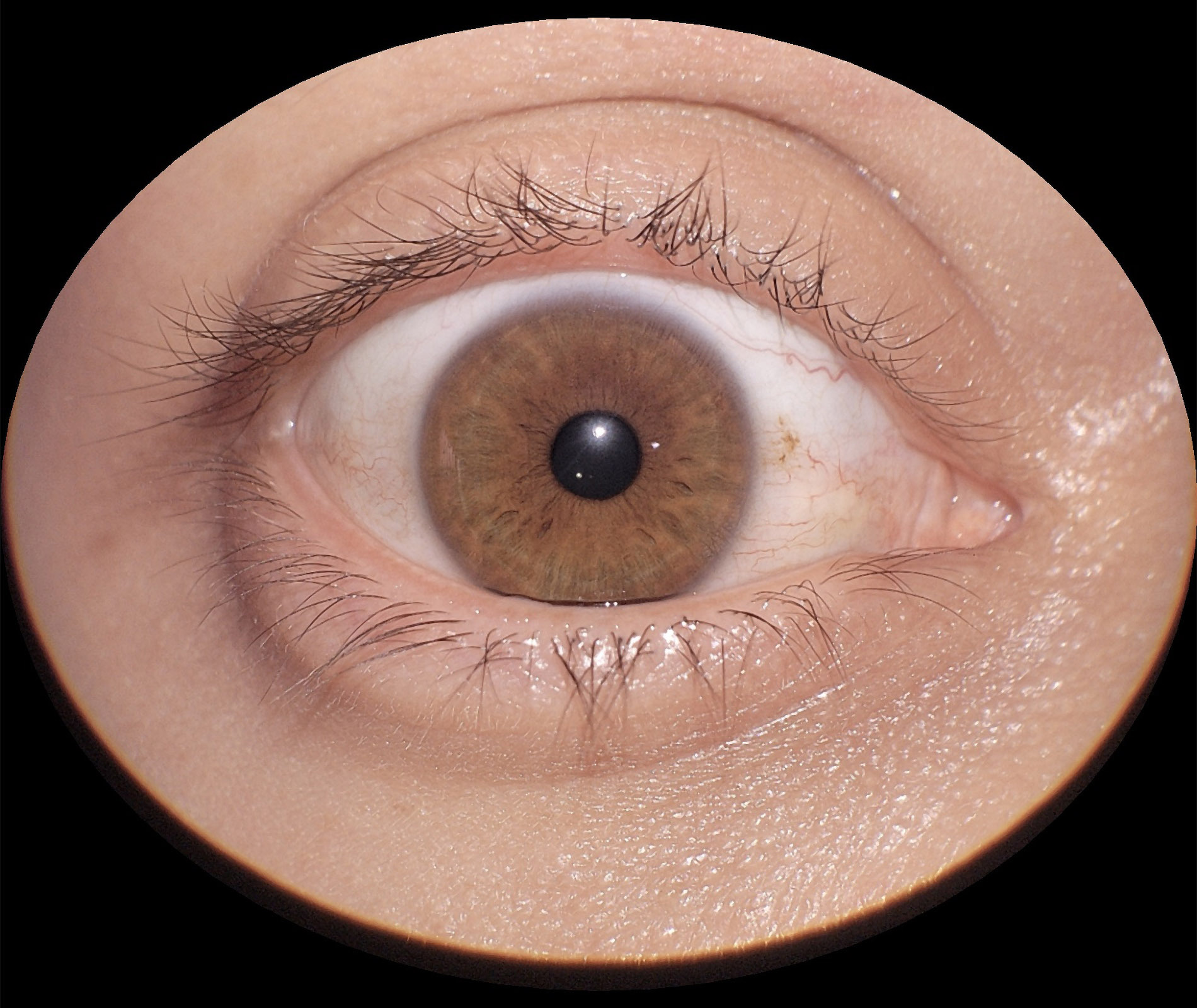 img_segmento_anterior_eyer2_09