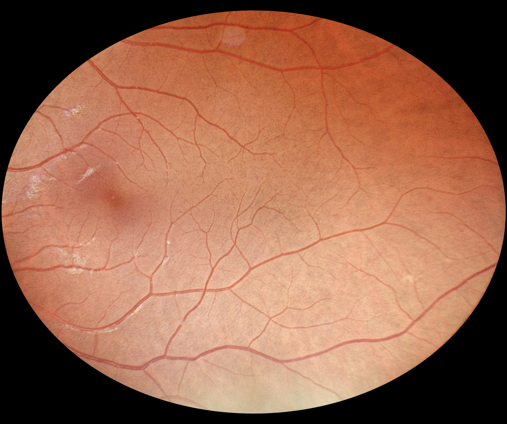 fundus_eyer2_4